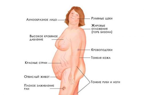 Проявления синдрома Иценко-Кушинга