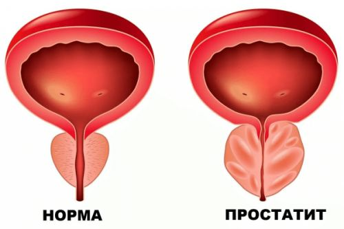 prostatit (1)
