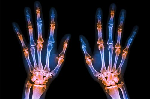 artrite-reumatoide-rheumatoid-arthritis-1